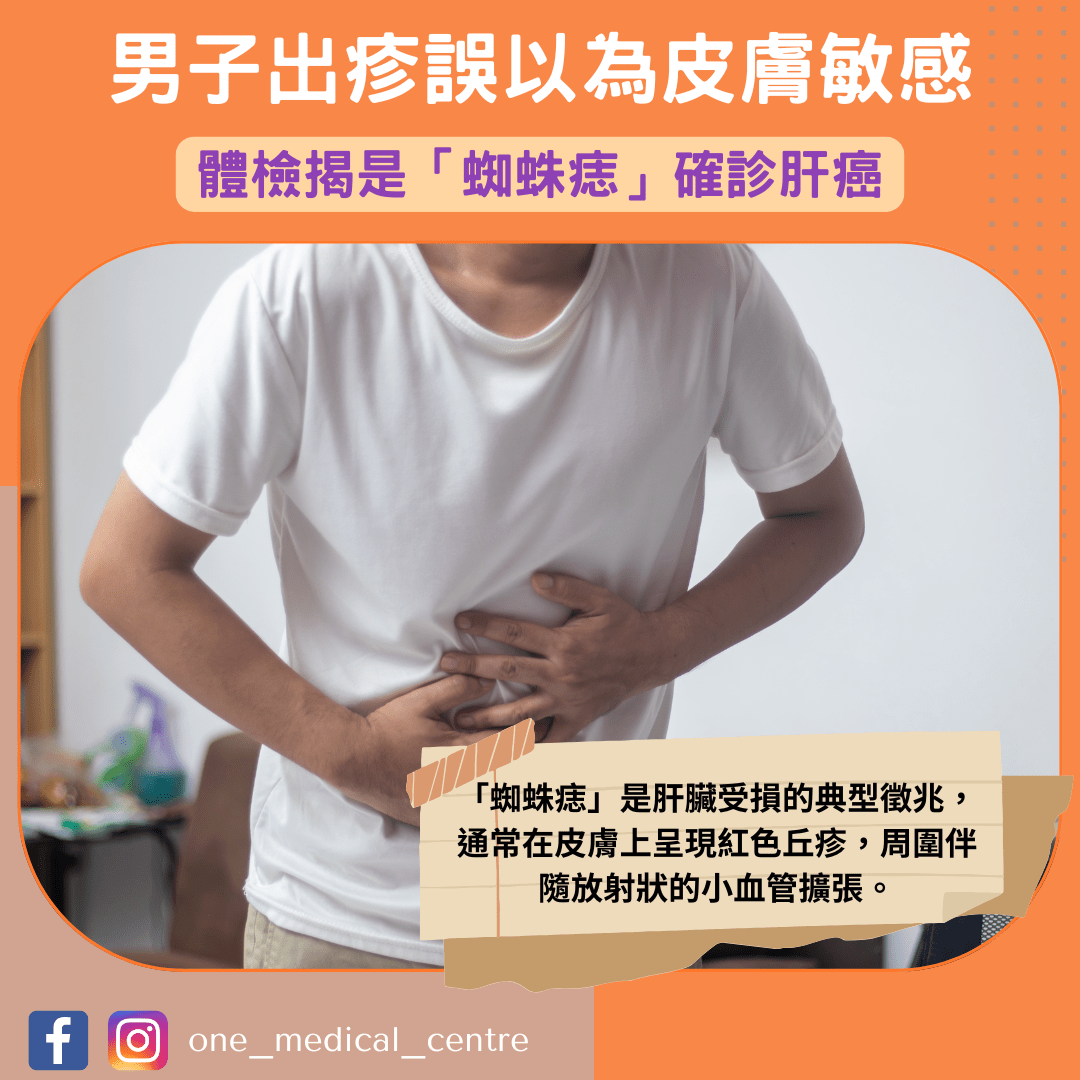 【男子出疹誤以為皮膚敏感　體檢揭是「蜘蛛痣」確診肝癌】